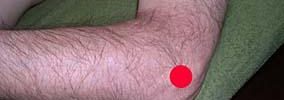 Tennis Elbow