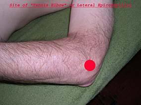 Tennis Elbow